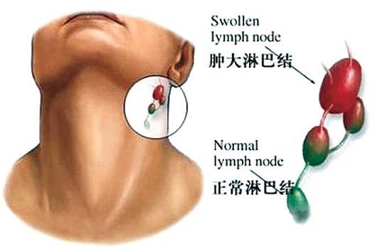 因甲醛超標而引起的淋巴癌怎么辦? 因甲醛超標而引起的淋巴癌怎么辦?
